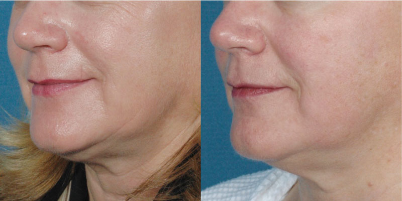 サブライムアプリケーター