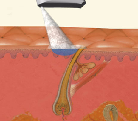 ジェントルMAX Proの冷却システム