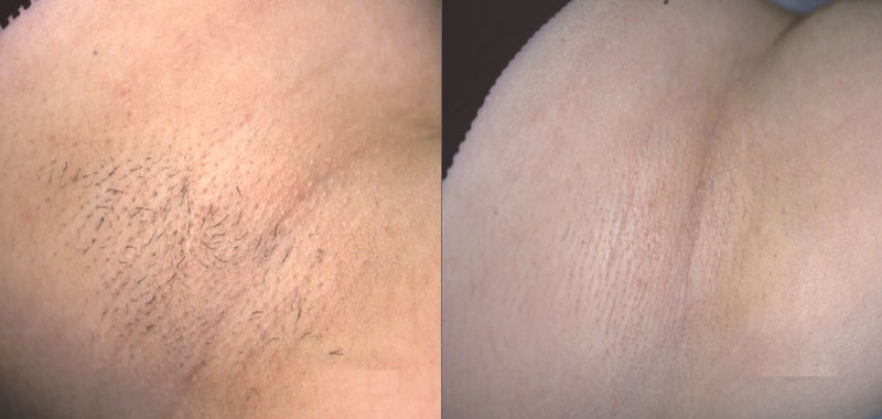 ジェントルMAX Pro