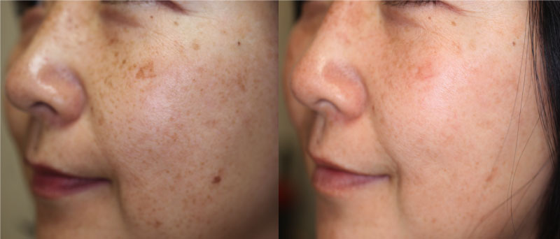 ジェントルMAX Pro