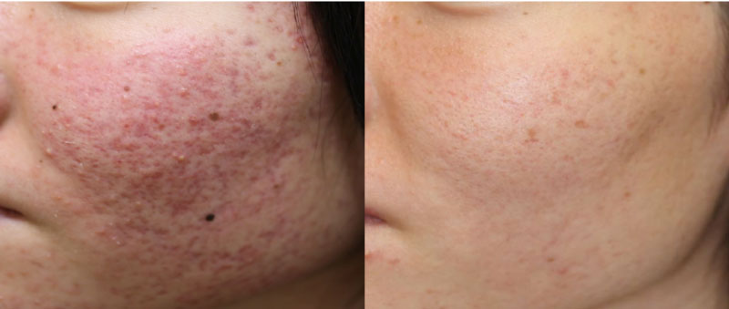 ジェントルMAX Pro