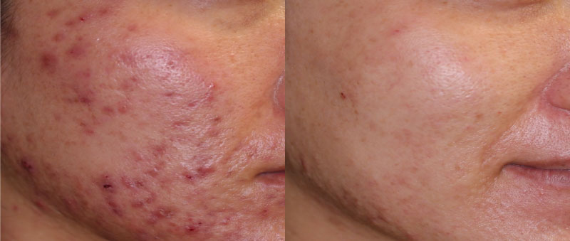 ジェントルMAX Pro