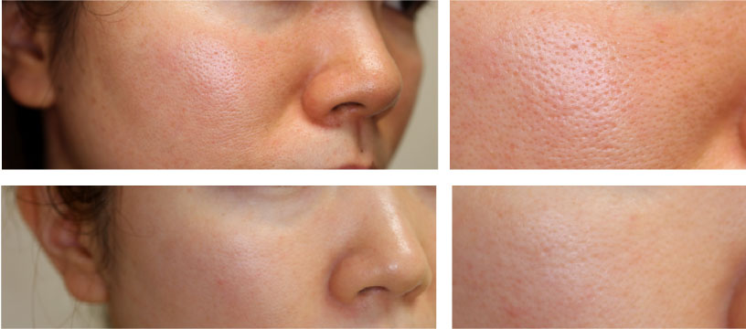 ジェントルMAX Pro