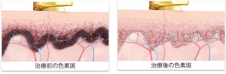 ピコウェイのフラクショナルハンドピース