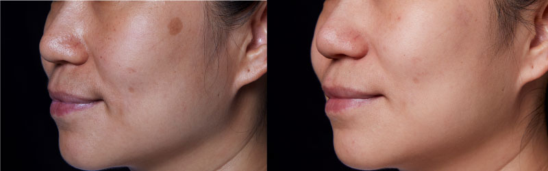 ピコウェイの良性色素斑治療