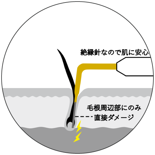 医療針脱毛・ニードル脱毛