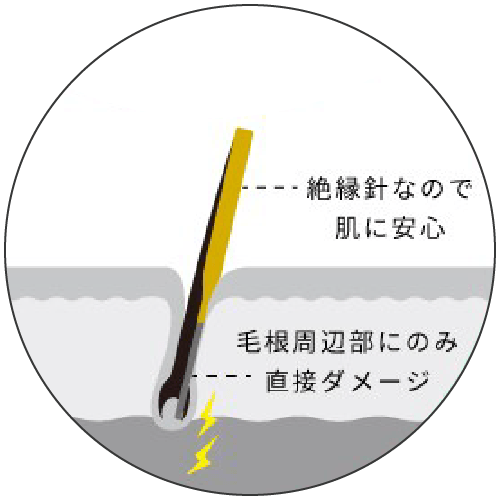 医療針脱毛・ニードル脱毛
